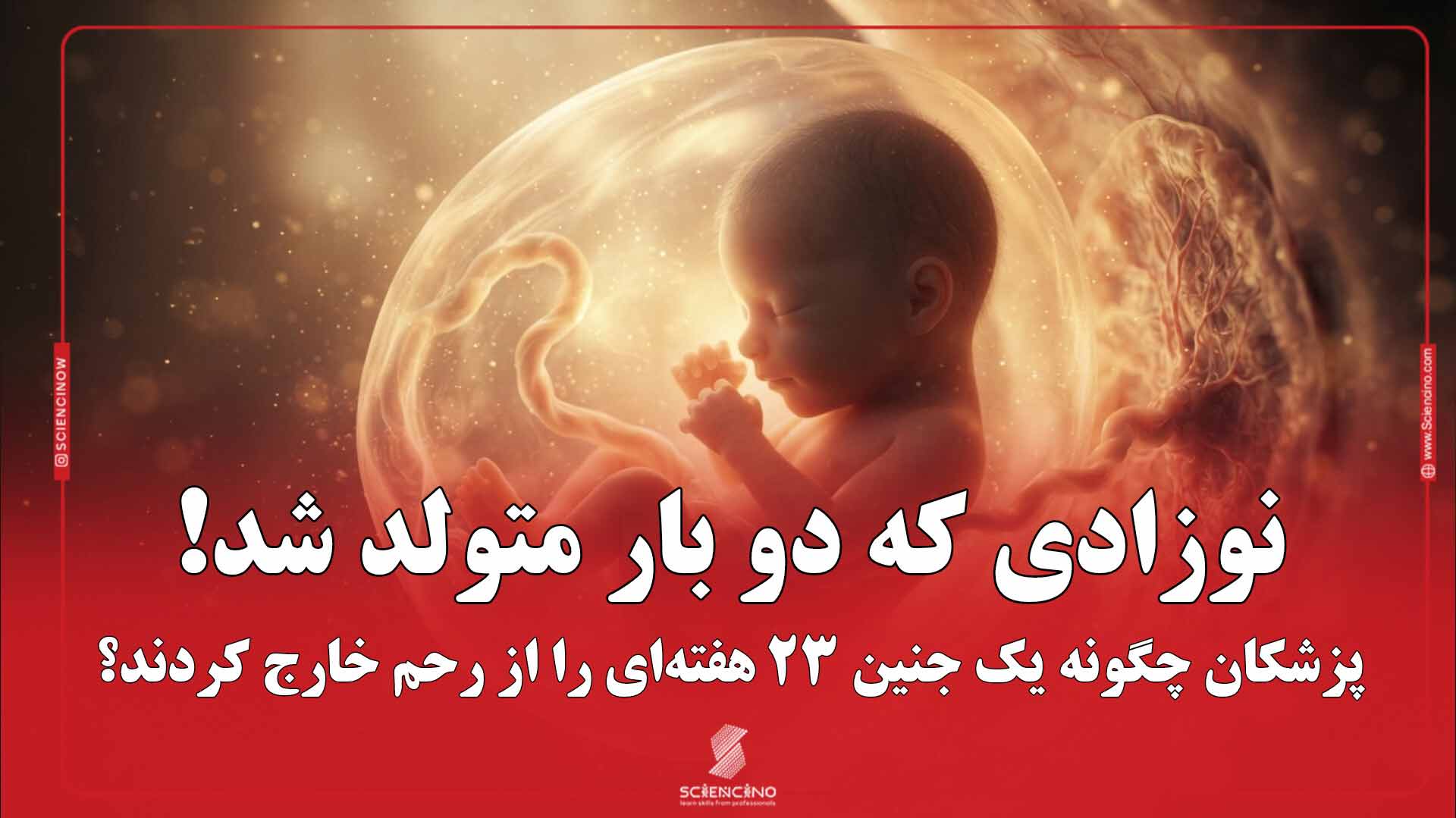 نوزادی که دو بار متولد شد